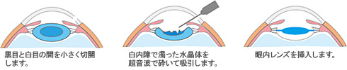 白内障手術の実際